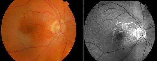 视网膜中央动脉阻塞图片