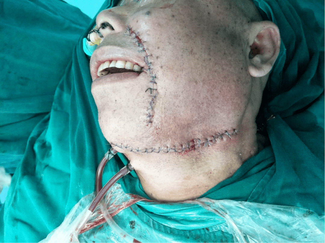 口腔癌术后脸部照图片