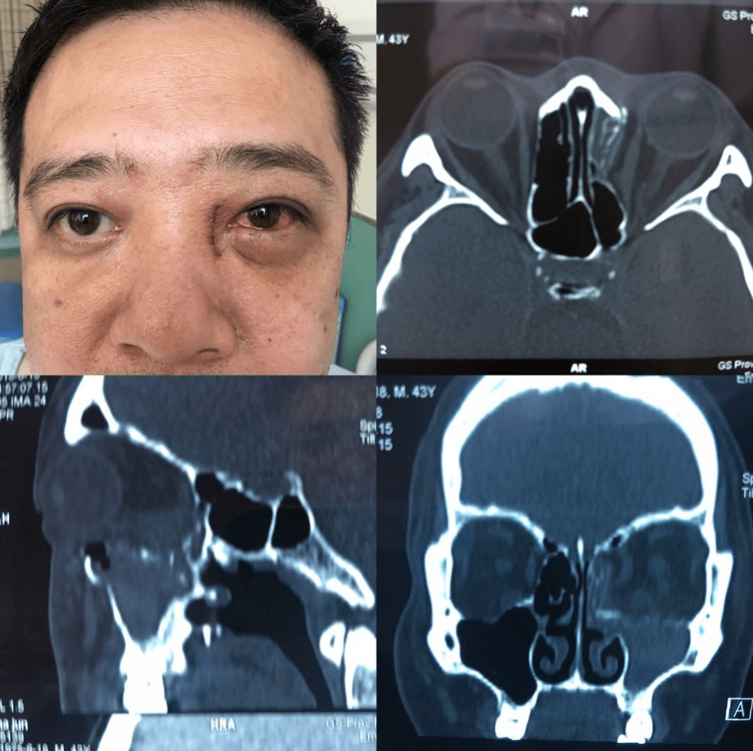 省二院眼科薛尚才团队经典手术集锦_眼眶
