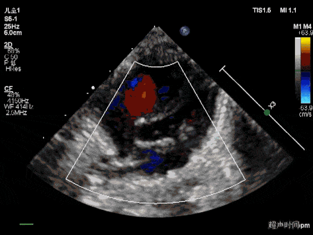 正常4条肺静脉超声图图片