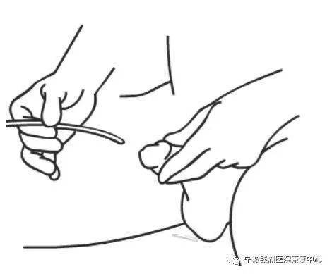 而产生一系列并发症的疾病总称,间歇导尿可使膀胱规律性充盈与排空接