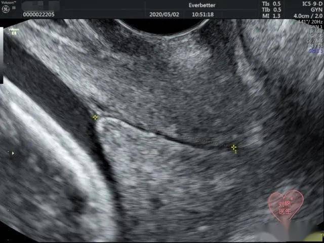 宫颈长度的超声检查