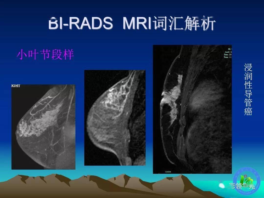 乳腺影像丨乳腺病變磁共振基本徵象分析與診斷進展