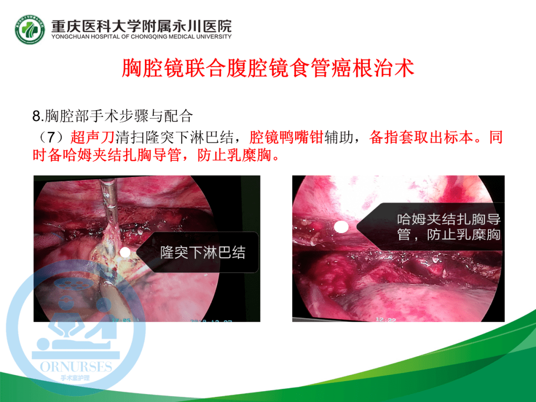 ppt胸腔镜联合腹腔镜食管癌根治术的手术配合