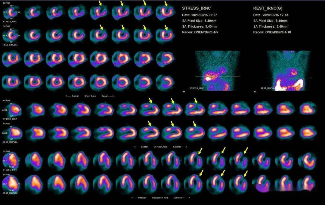 27.心肌静息-负荷显像提
