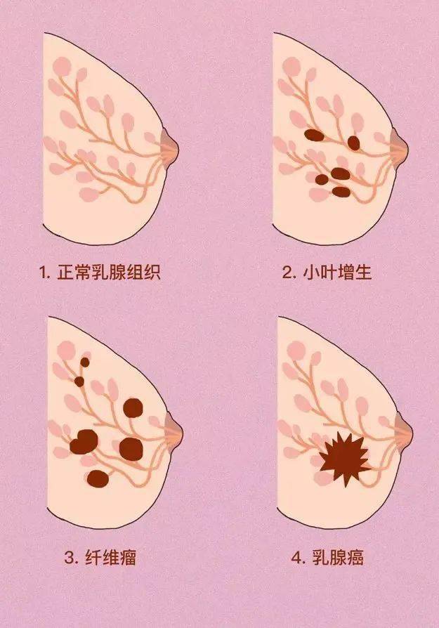 乳腺癌的症状 凹陷图片