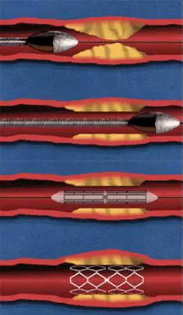 冠脉旋磨术用物理的方法将动脉硬化斑块祛除,虽然技术难度高,但对于