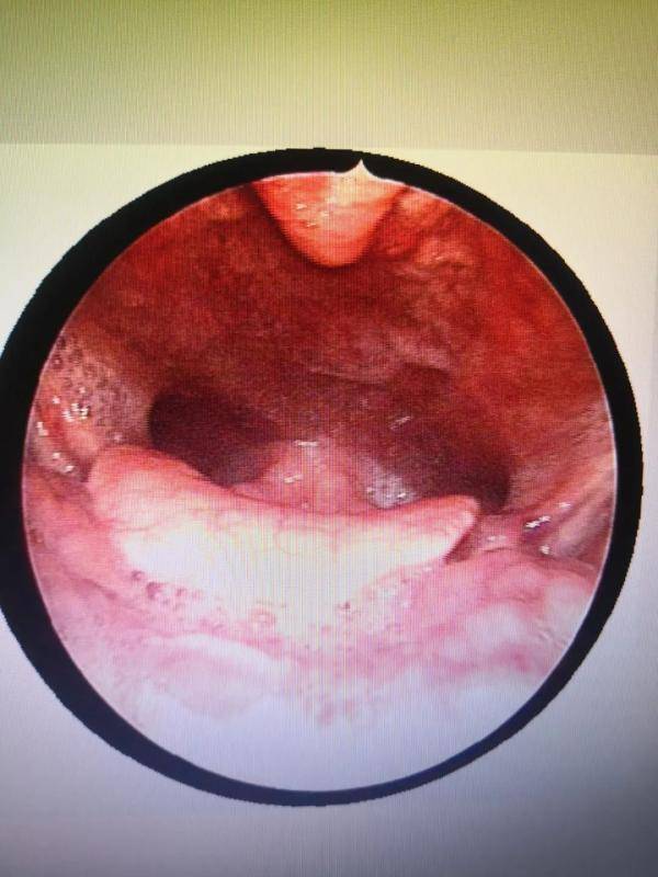 "我吞了一只蜜蜂,喉咙很痛"这样的情况,连医生都说头回碰到!