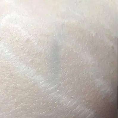 鸡皮肤的英文(鸡皮肤学名叫什么)