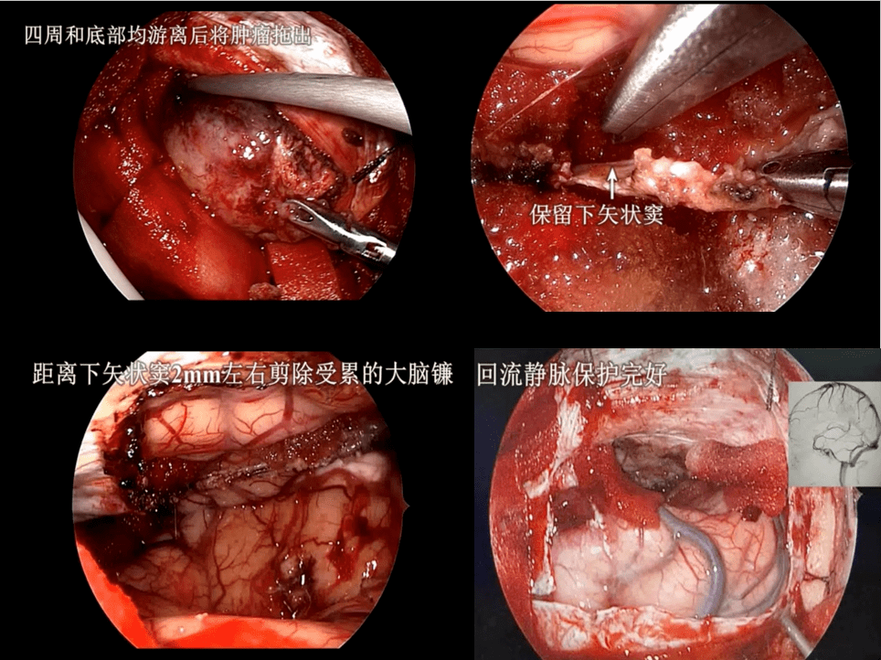 【新闻快递】外三科一组成功开展医院首例神经内镜下左额顶深部大脑镰