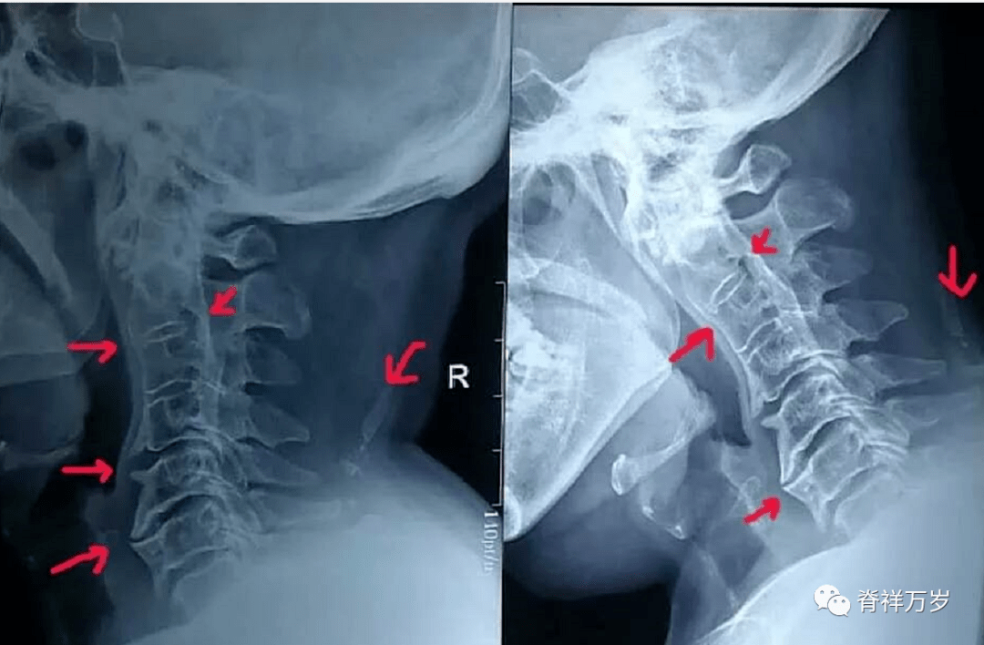 颈椎有个凸出来的骨头图片