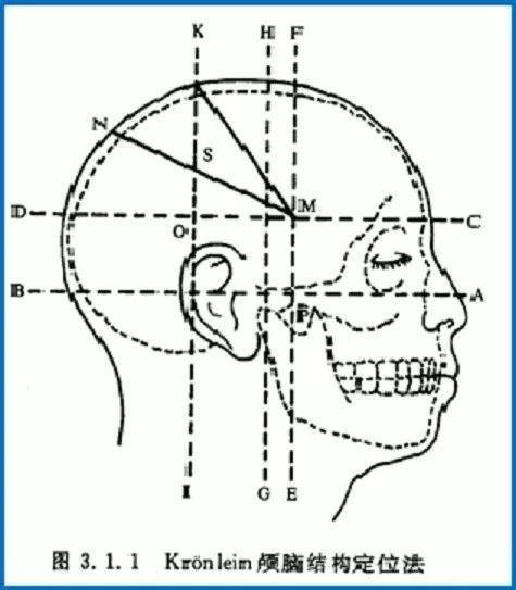 在矢状线上画一条线,连接鼻根点和枕外隆凸点,以此线为基础,标出连线