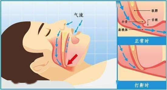 打呼噜就是睡得香它可能是病得治