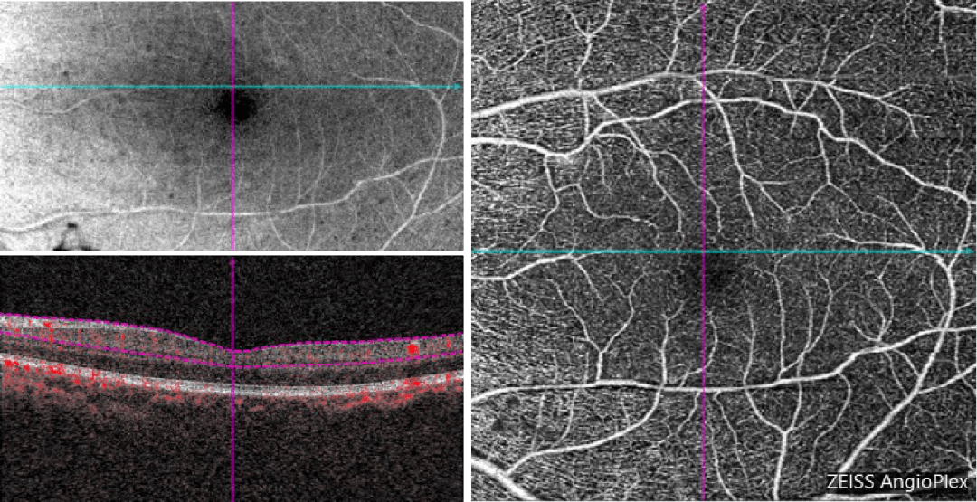 颞上区域见黄白色渗出octa & 结构 6x6mm 双眼视盘结构en face