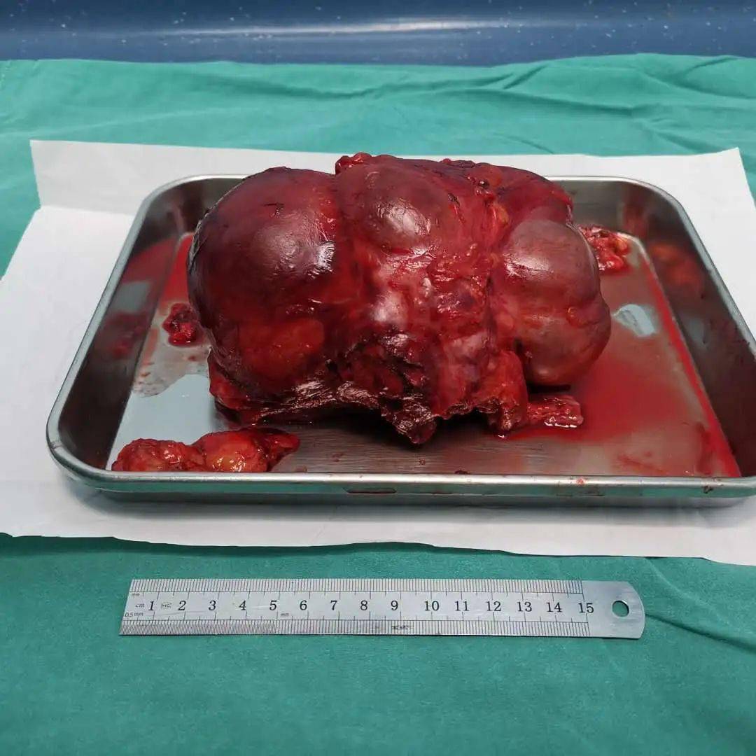 特别关注┃结石 久拖成癌_肿瘤