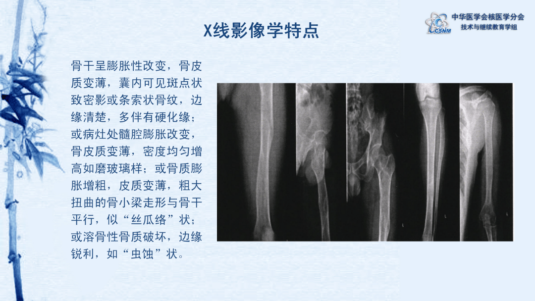 讲座79期肖茜骨纤维结构不良spect全身骨显像特点及其临床概述