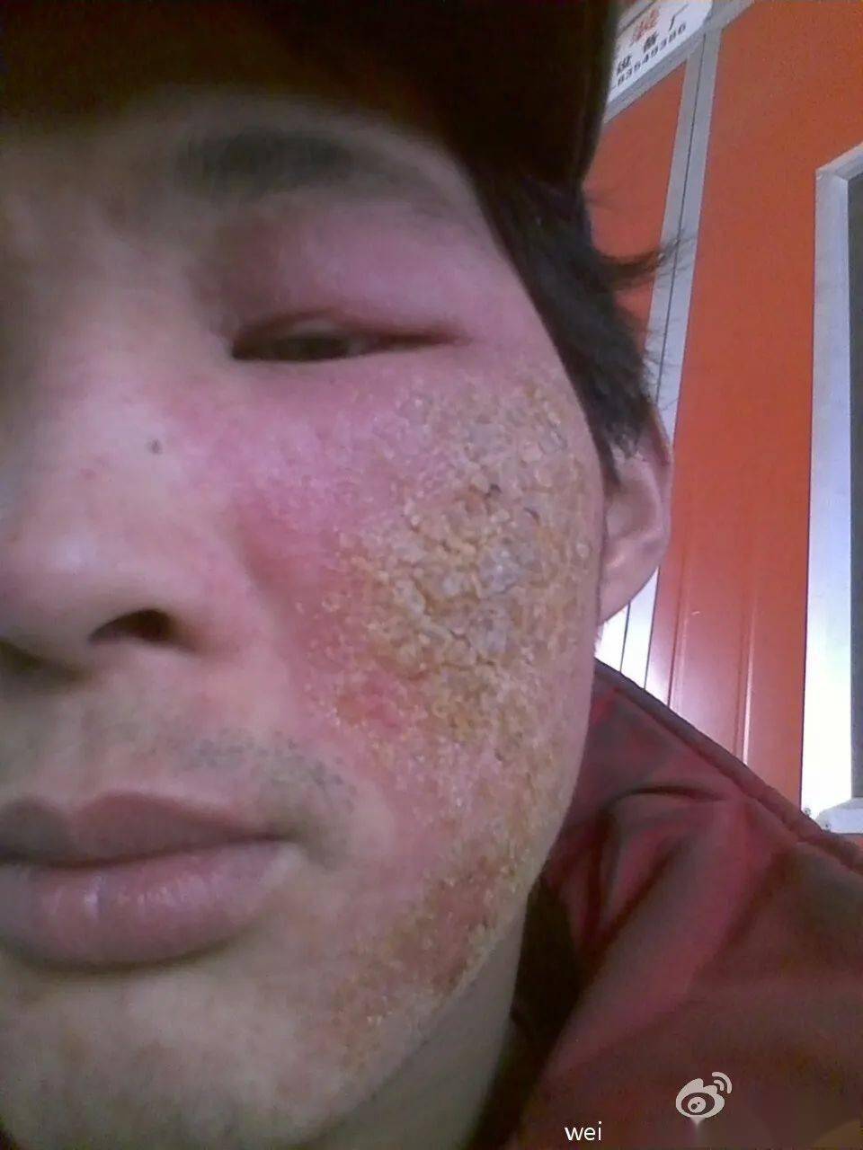 梦境解析，梦到自己脸如鸡蛋脱皮，右脸溃烂黄迹