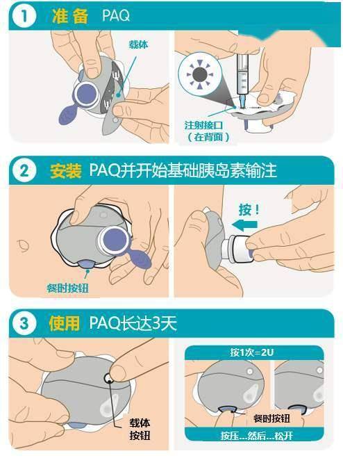 最简单的胰岛素泵使用技巧大全糖尿病人尤其需要注意这几个细节