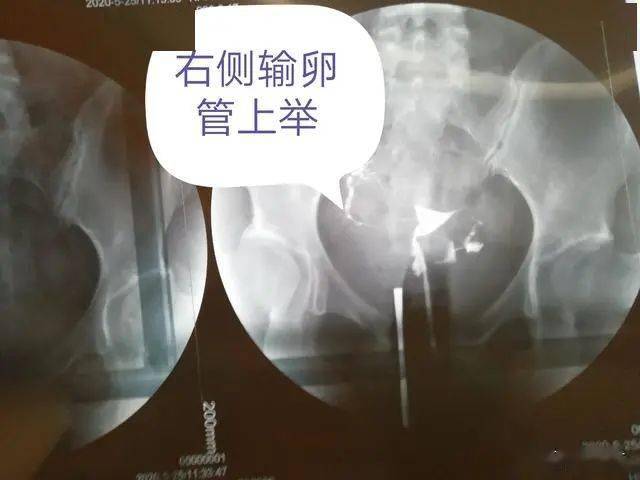 输卵管造影结果输卵管上举我还能自己怀孕吗