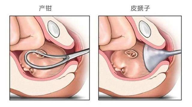 依然可选择产钳助产,因为胎头吸引助产很可能失败[3]