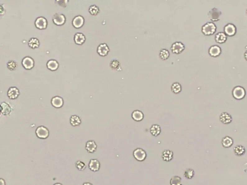 利用红细胞形态区分肾小球性血尿和非肾小球性血尿,经过国内外学者多