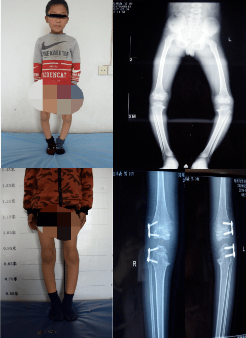 兒童羅圈腿長短腿不可怕微創治療有辦法小兒骨科Ⅱ脊柱側彎科11週年