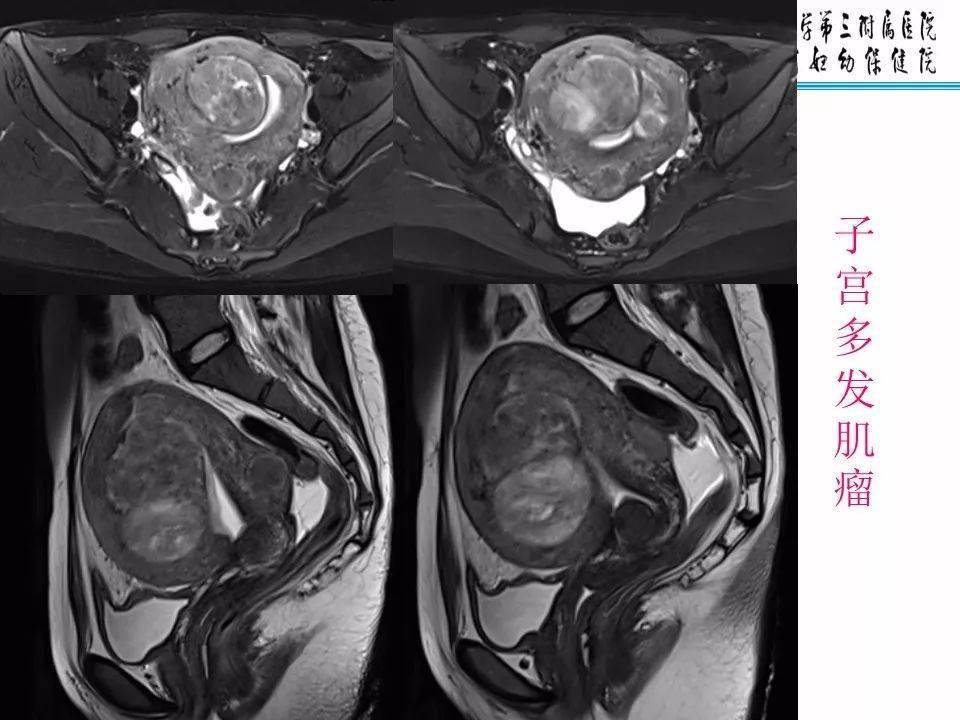 子宫常见肿瘤的mri表现