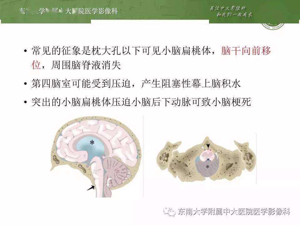 必點收藏顱內疝影像彙總