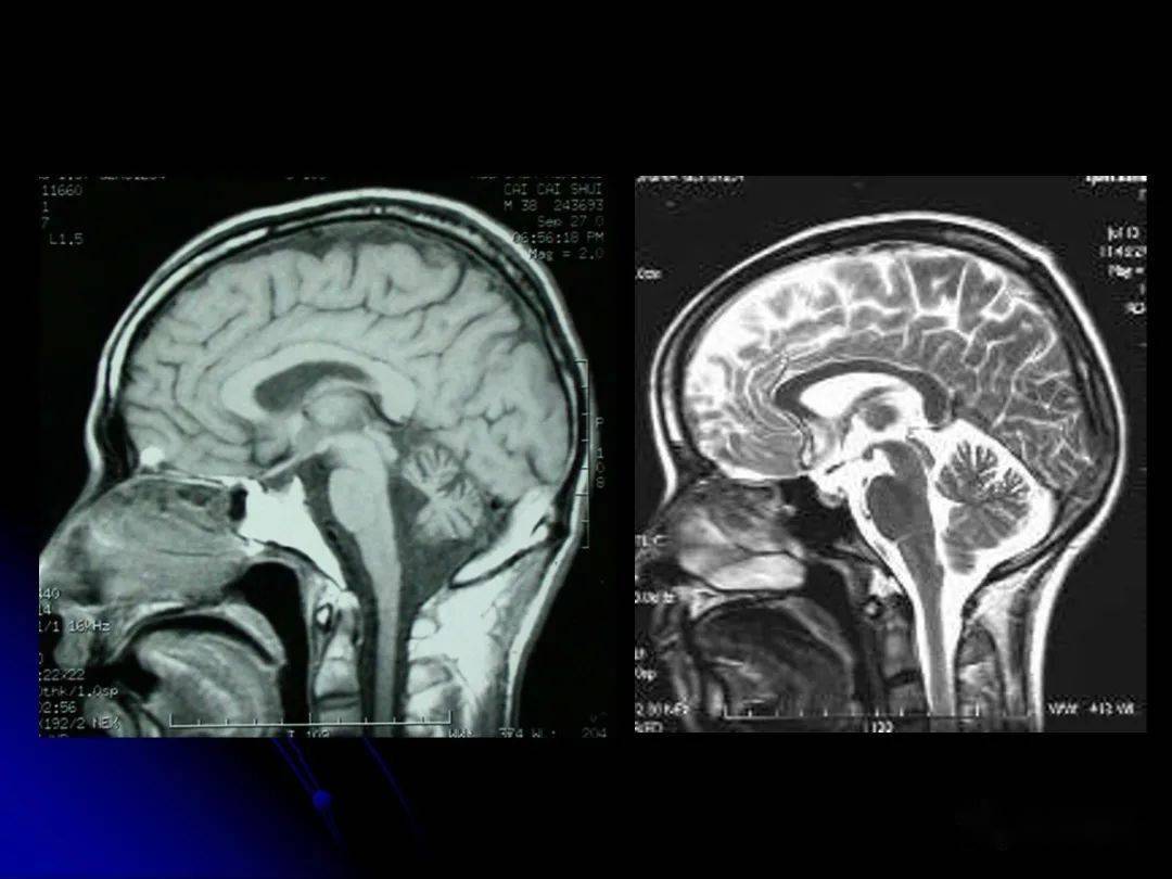 脑干区常见病变影像表现