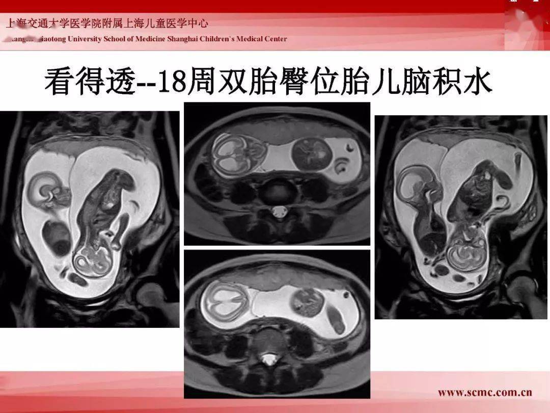 胎儿磁共振的检查技术