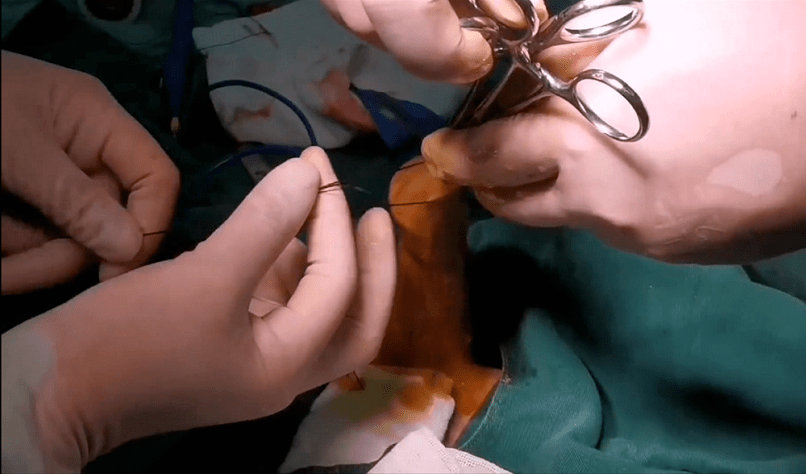 手术演示丨吻合器包皮环切术