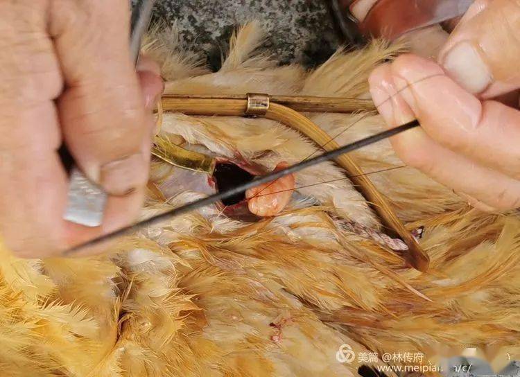 高清大图实拍_结扎手术