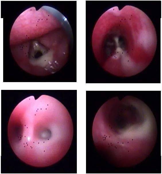 6年反复咳嗽的病因终于找到了