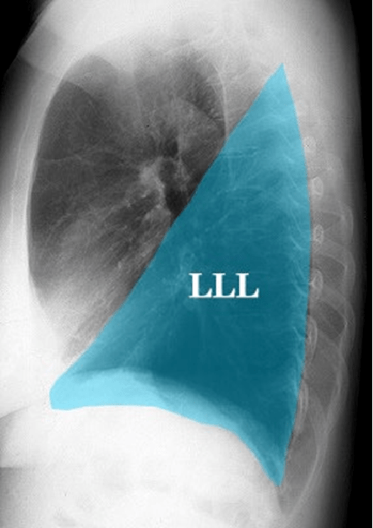 肺斜裂图片图片
