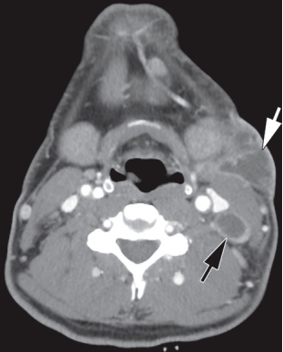 颌下腺ct解剖图图片