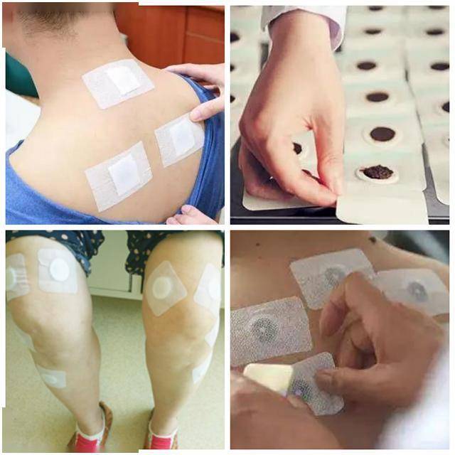 三伏贴是穴位贴敷疗法中最常用的方法之一.