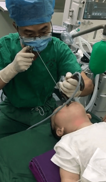 当天晚上8时20分,在全麻 直达喉镜的支撑下,仅仅20秒钟,医生成功取出