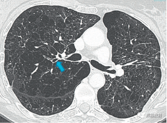 吸菸患者重度小葉中央型肺氣腫advanced centrilobular emphysema in