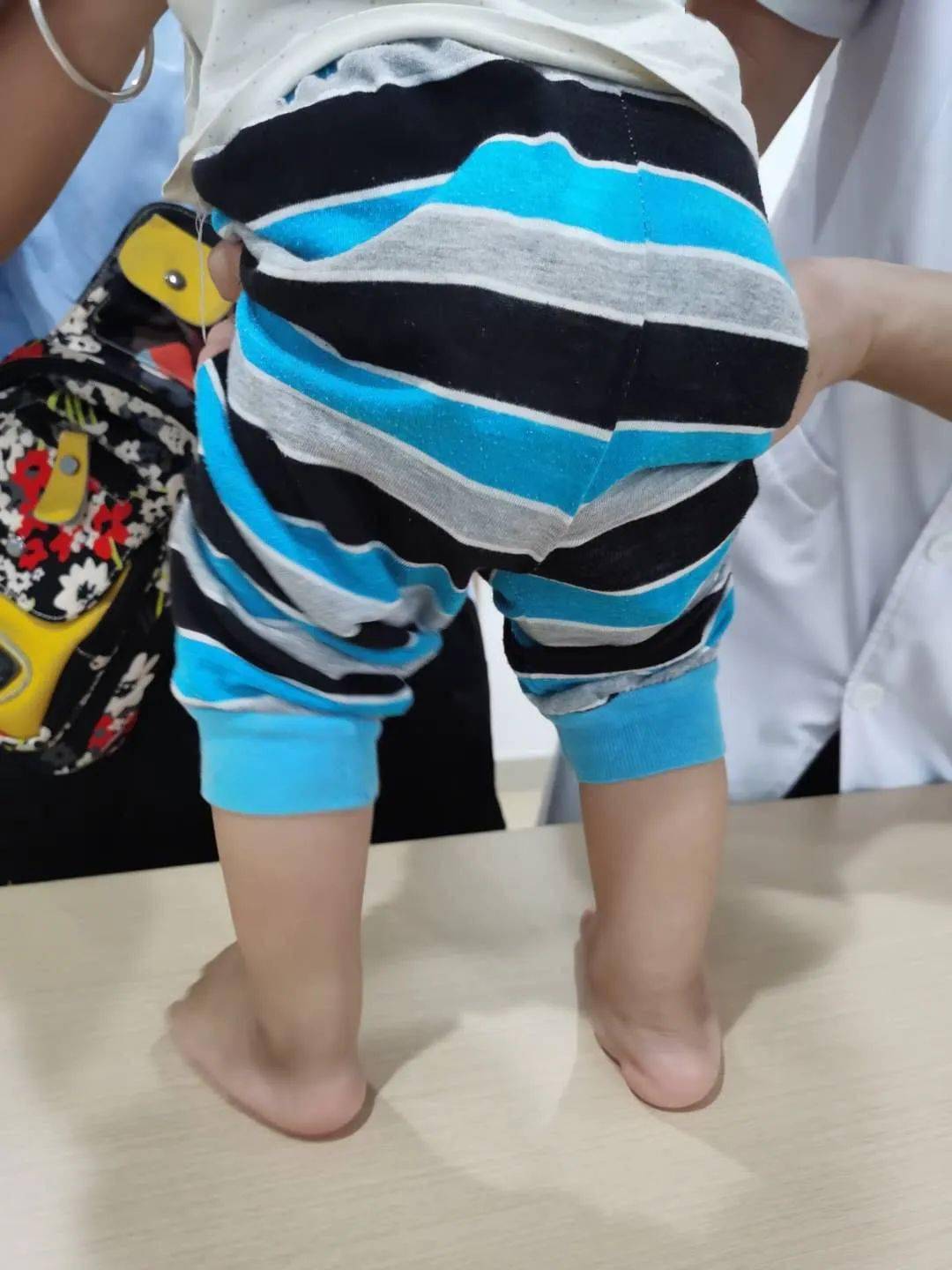 石膏数次固定及佩带支具等方法治疗先天性马蹄内翻足症状表现