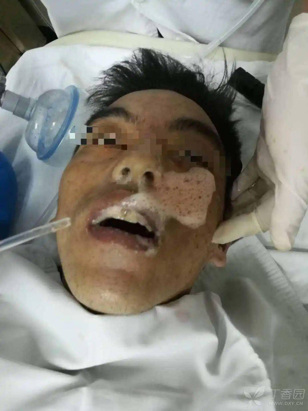 喝下2 瓶啤酒后,意识模糊口吐血色泡沫,入院抢救无效死亡!