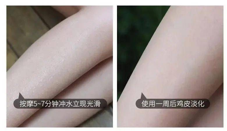 暗沉型鸡皮肤怎么治疗的简单介绍