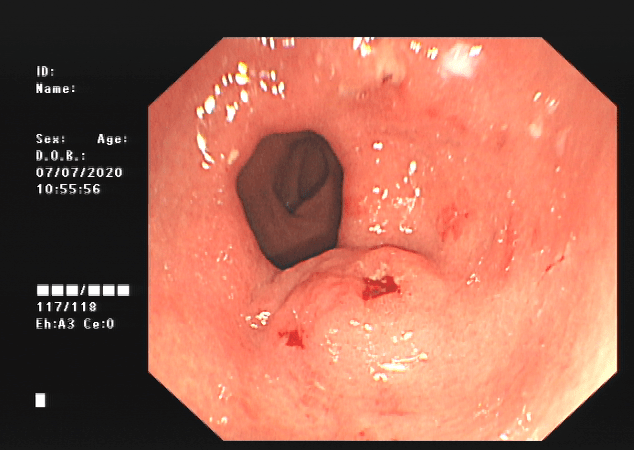 "囫囵吞枣"要不得,一女性患者吞枣核卡在胃里_胃镜