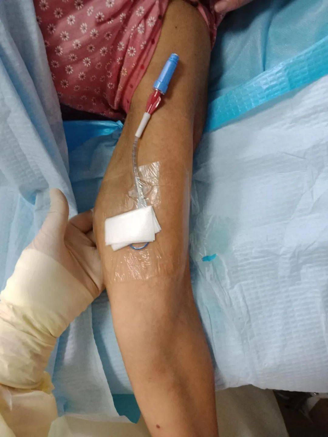 血液内分泌之picc篇