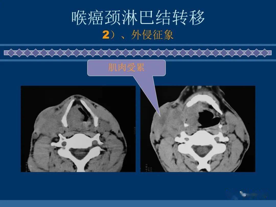 2),大小不等,邊界清晰頸靜脈鏈周圍,氣管食管溝,縱隔1),部位1,甲狀腺