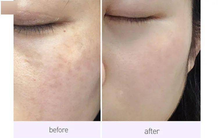 四五十岁不长斑的秘密,除了防晒,还能做什么?