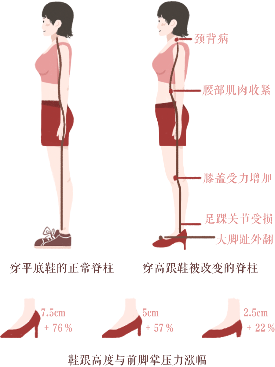 大部分女生有骨盆前倾问题都是因为长期穿高跟鞋引起的,因为在站立或