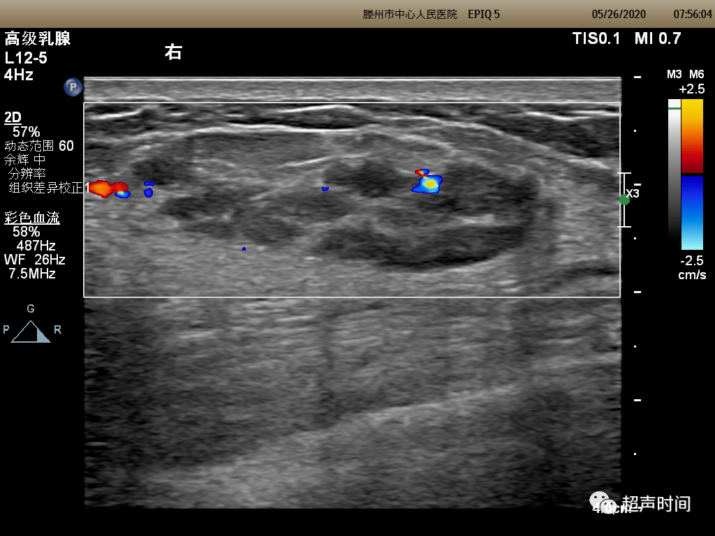错构瘤超声图片