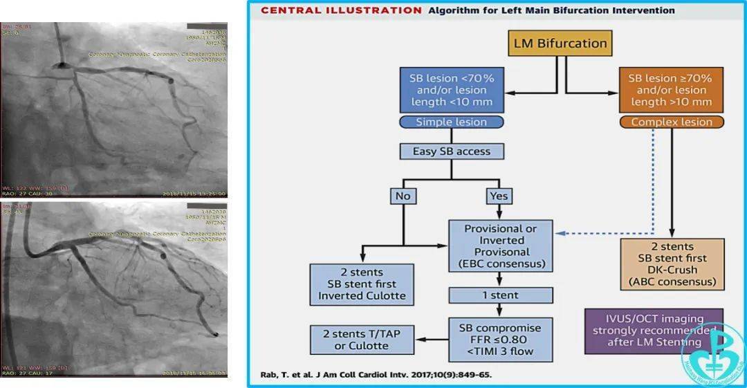 cici大会oct参赛病例oct指导dkcrush术式治疗左主干分叉病变