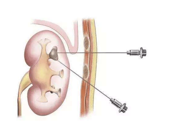 经皮肾镜碎石术手术操作示意图