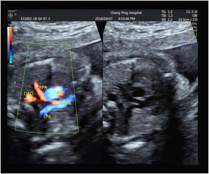 超声典型病例胎儿法洛四联症合并右位主动脉弓